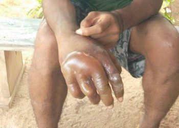 Sadis, Guru STM di Flotim Siksa Murid Celupkan Tangan Ke Air Panas